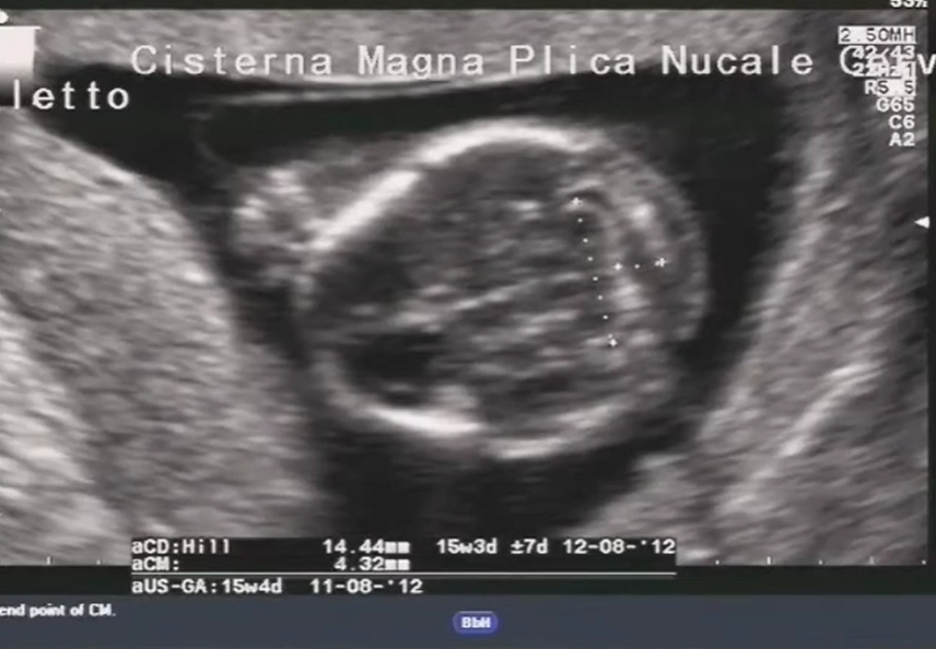 Tồn tại ổ nhớp (Cloacal Malformation) / Xoang niệu sinh dục (Urogenital Sinus)