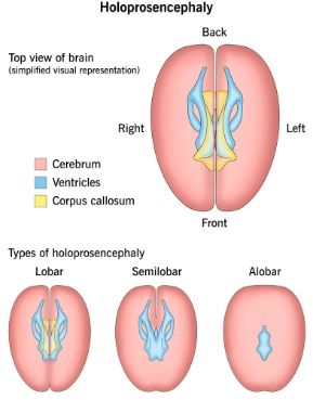 HOLOPROSENCEPHALY (HPE) - TẬT NÃO TRƯỚC KHÔNG PHÂN CHIA