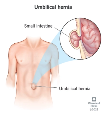 Thoát vị rốn (Umbilical Hernia)