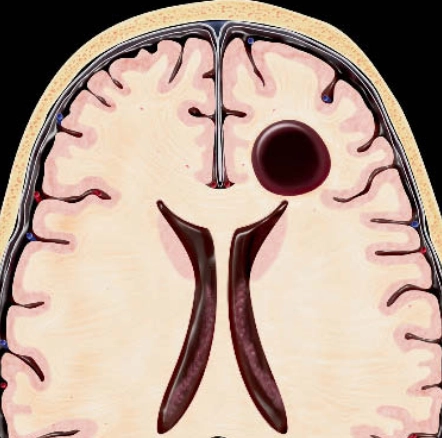 Nang thần kinh đệm (Neuroglial cyst - NGC)