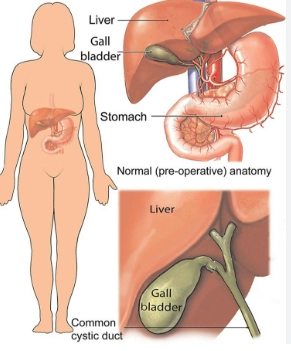 Viêm túi mật hoại tử sinh hơi (Emphysematous Cholecystitis)