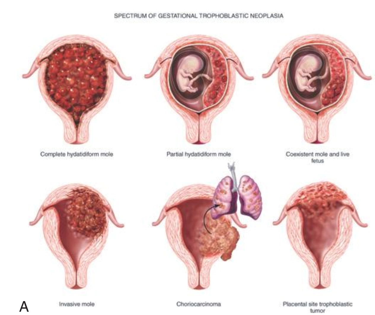 Thai trứng bán phần (Partial hydatidiform mole)