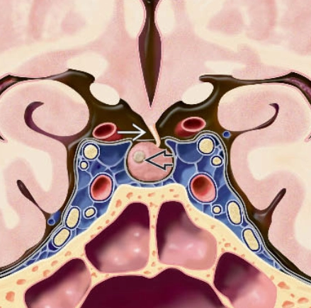 U tuyến yên nhỏ (Pituitary microadenomas)