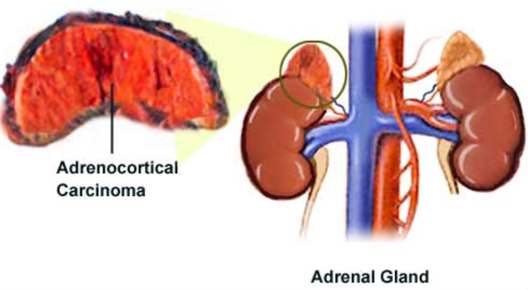 Carcinoma vỏ thượng thận (Adrenal cortical carcinoma)