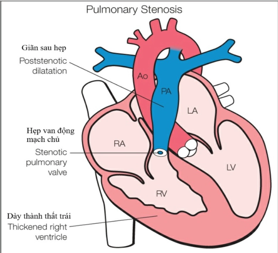 Hẹp van động mạch phổi