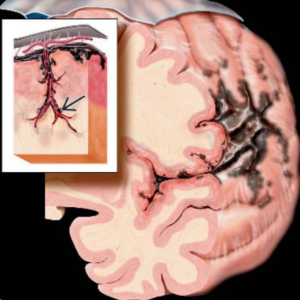 Bệnh hắc tố thần kinh da (Neurocutaneous Melanosis -NCM)