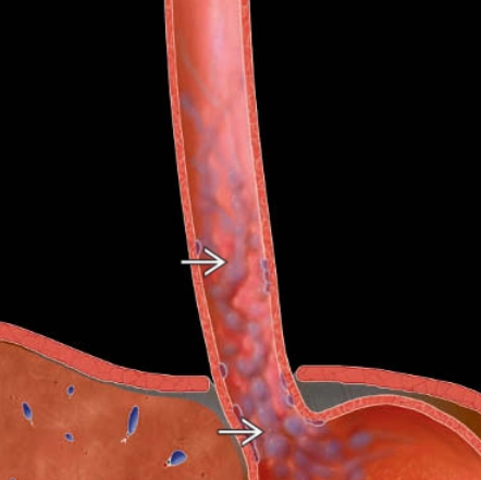 Tăng áp lực tĩnh mạch cửa (Portal Hypertension)
