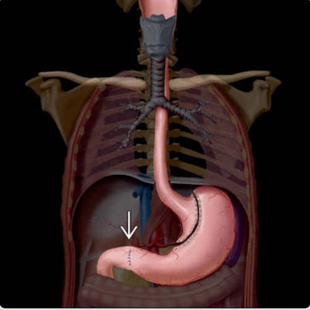 Phẫu thuật cắt bỏ thực quản Ivor-Lewis (Ivor-Lewis procedure)