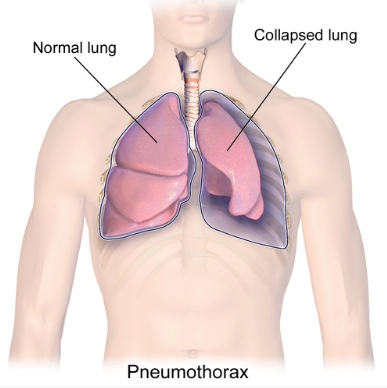 Tràn khí màng phổi (Pneumothorax)