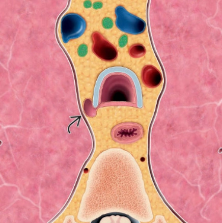 Nang khí cạnh khí quản (Paratracheal air cysts)