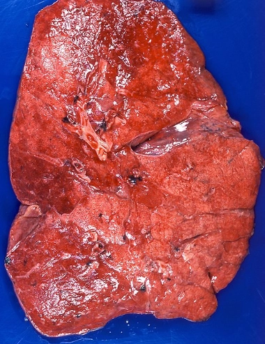 Viêm phổi do mỡ (Lipoid pneumonia - LP)