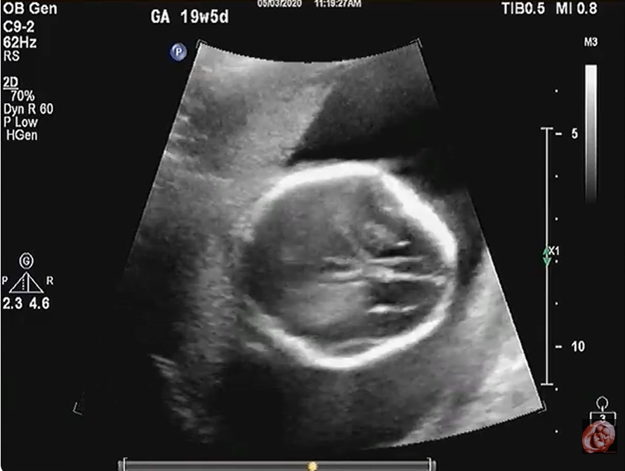 Loạn sản xương gây chết thai nhi (Thanatophoric Dysplasia - TD)