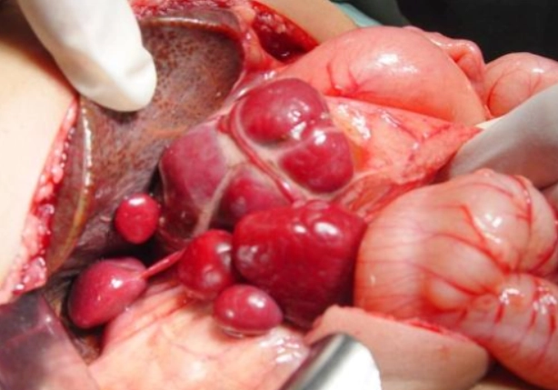 Hội chứng đa lách (Polysplenia syndrome)