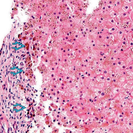 Gan ứ đọng sắt (Hemochromatosis)