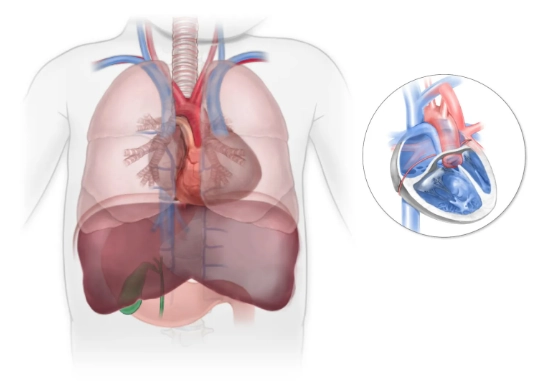 Hội chứng vô lách (Asplenia syndrome)