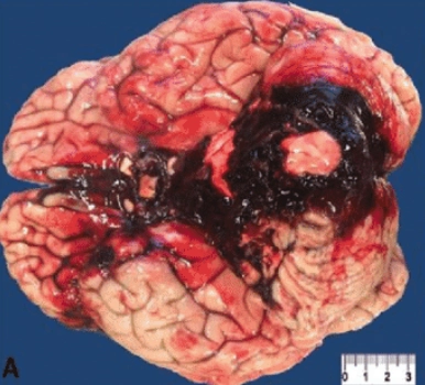 Viêm não do mắc Cytomegalovirus - Cytomegalovirus encephalitis (CMV)