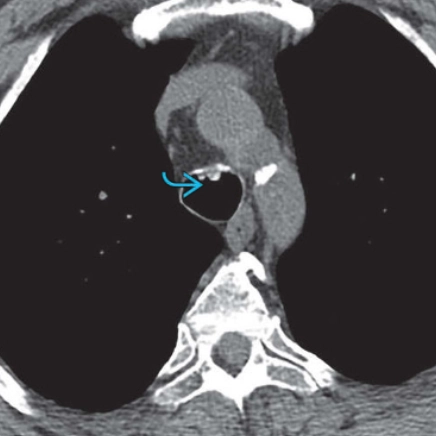 Bệnh cốt hóa-sụn khí phế quản (Tracheobronchopathia Osteochondroplastica - TO) 