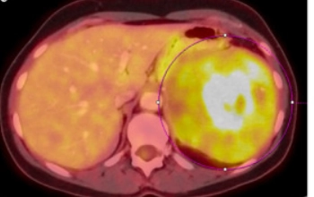 U mạch máu ác tính lách (Splenic angiosarcoma)