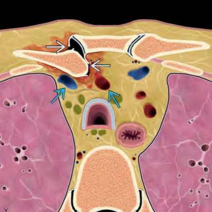 Trật khớp ức đòn (Sternoclavicular joint injury)