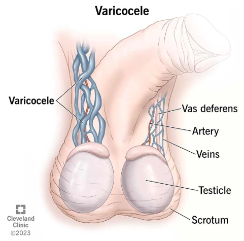 Giãn tĩnh mạch thừng tinh (Varicocele)