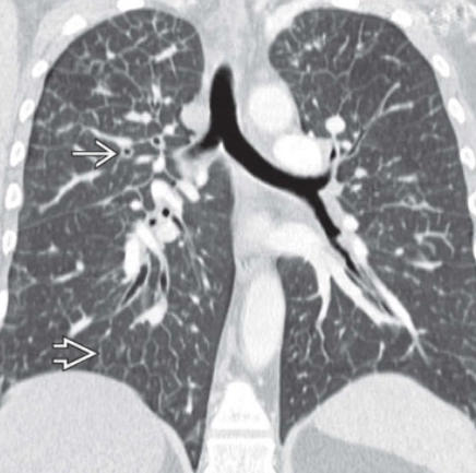 U mạch bạch huyết phổi lan tỏa (Diffuse pulmonary lymphangiomatosis - DPL)