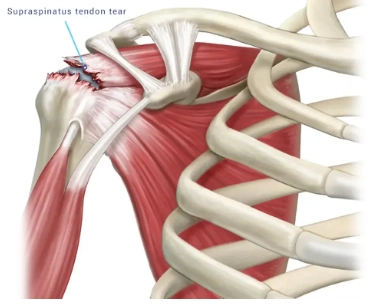 Rách gân cơ trên gai (Supraspinatus tendon tear)