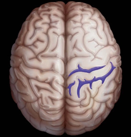 Xuất huyết dưới nhện lồi não- cSAH (Convexal Subarachnoid Hemorrhage)