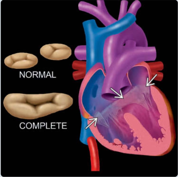 Kênh nhĩ thất toàn phần (complete AVSD)
