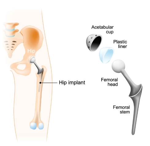 Thay khớp háng toàn phần (Total Hip Arthroplasty - THA)