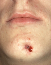 Đường dò (Sinus Tracts)