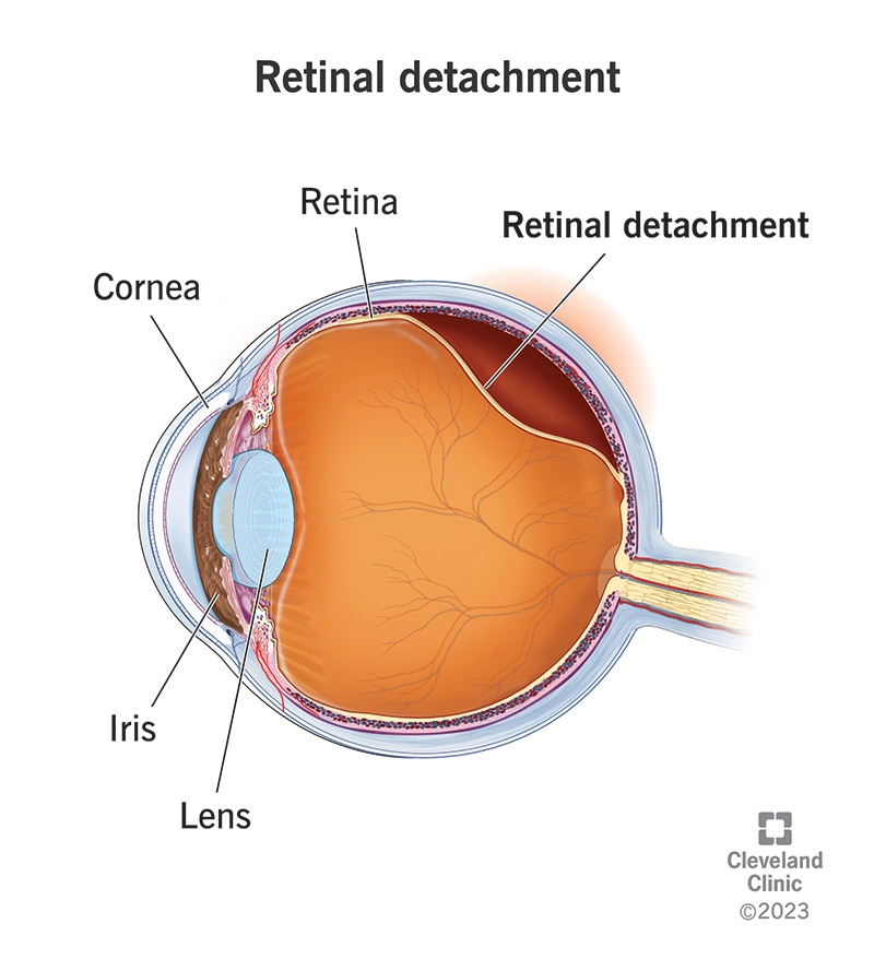 Bong võng mạc (Retinal detachment)