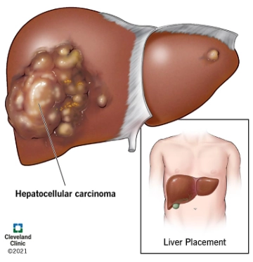 Ung thư biểu mô tế bào gan (Hepatocellular Carcinoma - HCC)