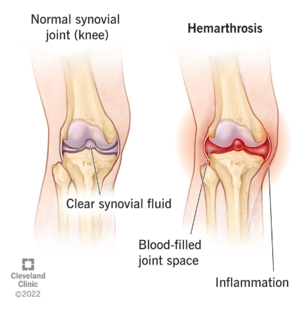 Bệnh khớp do Hemophilia (Hemophilic arthropathy)
