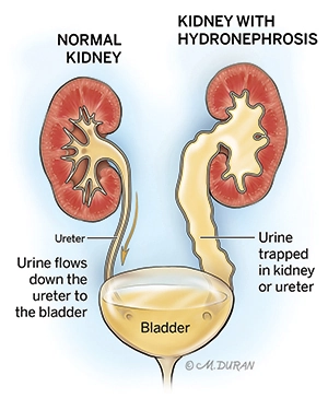 Giãn đường tiết niệu thai quý I