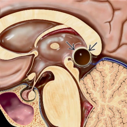Nang tuyến tùng (Pineal cysts)