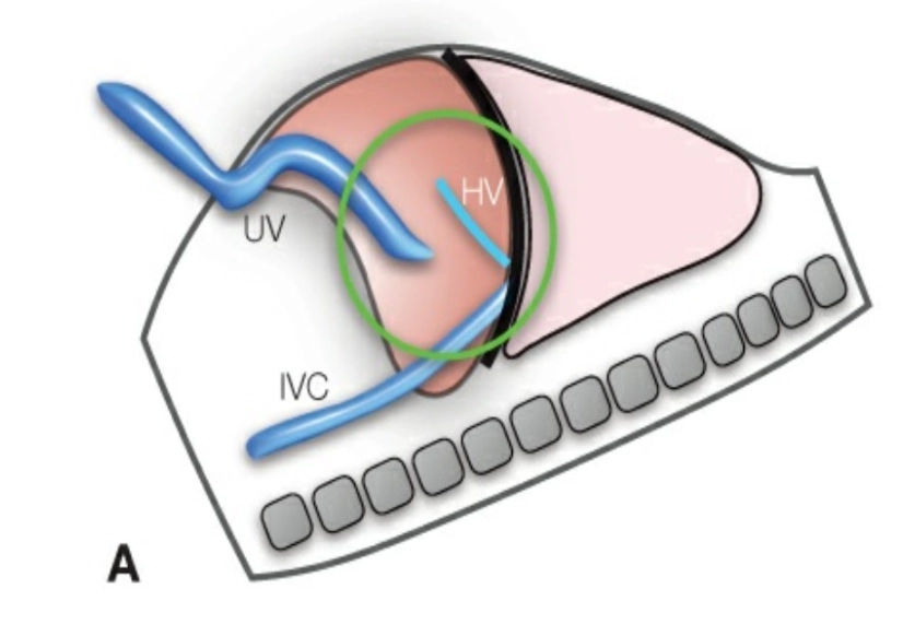 Shunt tĩnh mạch rốn- cửa- chủ (Bất sản ống tĩnh mạch DV)