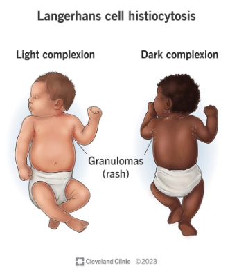 Biểu hiện ở xương của Bệnh mô bào Langerhans (Langerhans cell histiocytosis - skeletal manifestations)