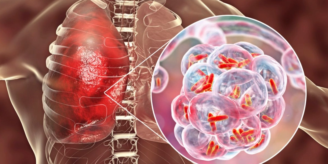 Viêm phổi mắc phải tại cộng đồng (Community-acquired pneumonia - CAP)
