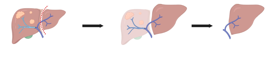Phân loại giai đoạn Ung thư gan (Hepatocellular Carcinoma staging)