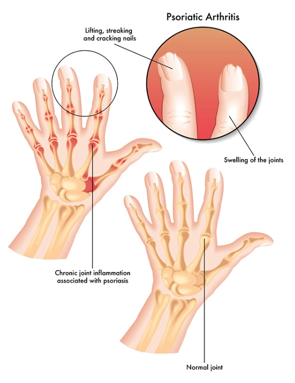  Viêm khớp vảy nến (Psoriatic arthritis - PsA)