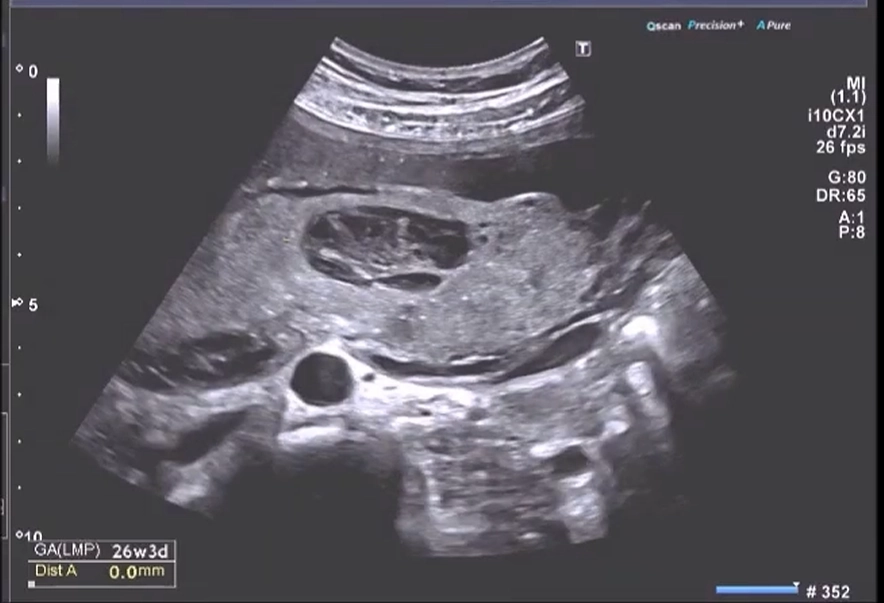 U quái bánh nhau (Placental Teratoma)