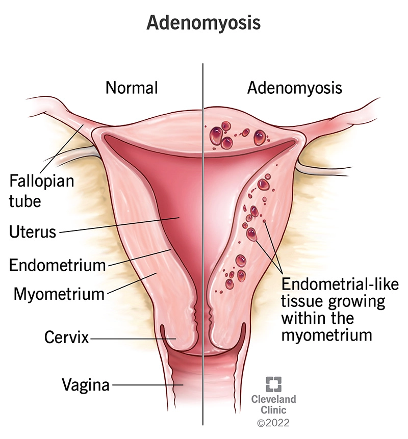 Bệnh cơ tuyến tử cung (Adenomyosis)