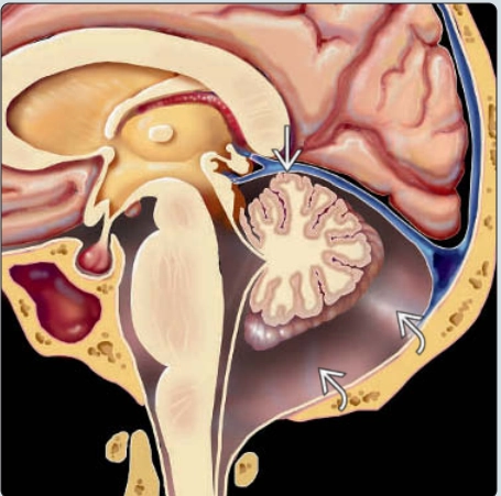 Thiểu sản tiểu não ở thai nhi (Global Cerebellar Hypoplasia)