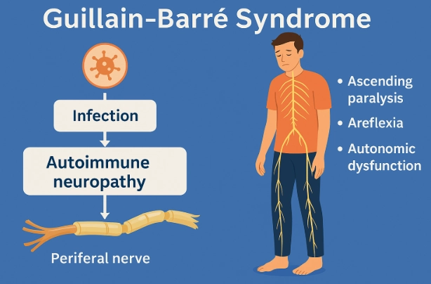 Hội chứng Guillain-Barré (Guillain-Barré syndrome - GBS)