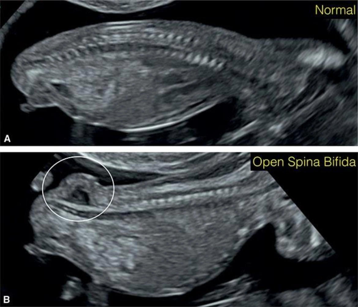 Tật chẻ đôi đốt sống thể hở (Open spina bifida)