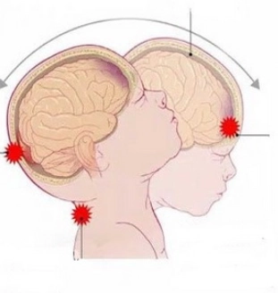 Chấn thương đầu do ngược đãi (Abusive head trauma - AHT) 
