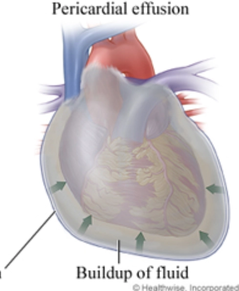Tràn dịch màng ngoài tim