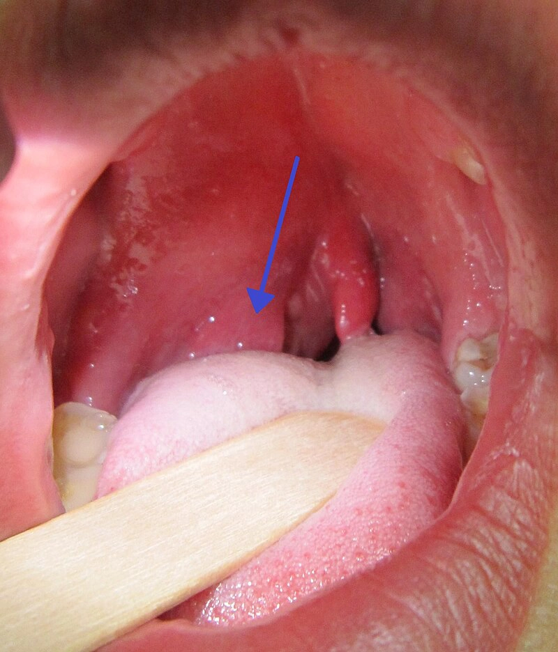 Áp xe quanh amidan (Peritonsillar abscess)
