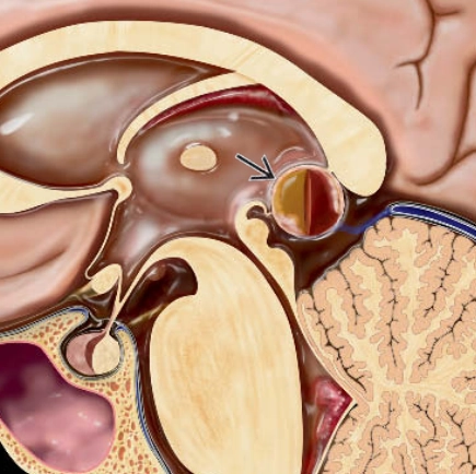 U tế bào tuyến tùng (Pineocytoma) 
