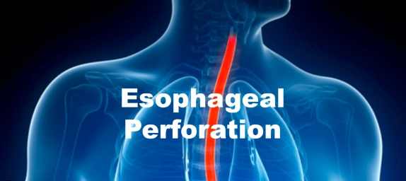 Thủng thực quản (Esophageal Perforation)